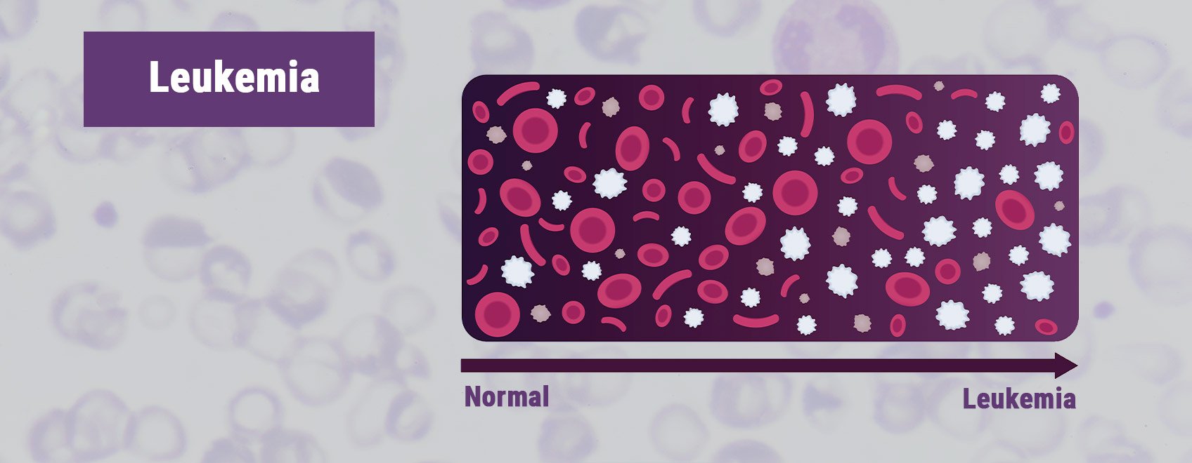 Leucemia Leucemia